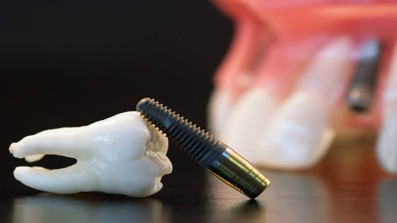 What You Should Know Before Getting Dental Crowns in Parker, CO