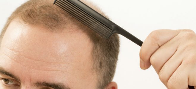 3 Common Causes of Hair Loss in Adults Throughout in Stockbridge, GA