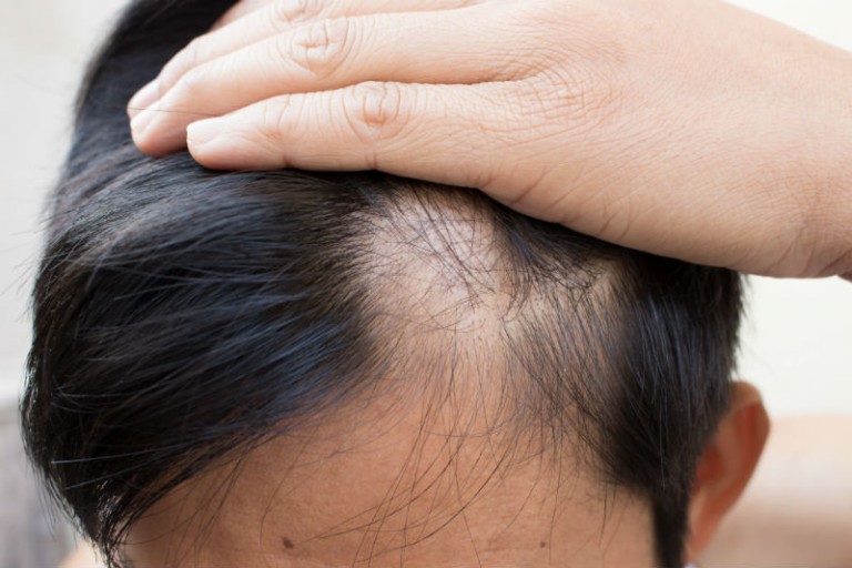 Understanding Hair Transplantation: Procedure, Recovery, and Considerations